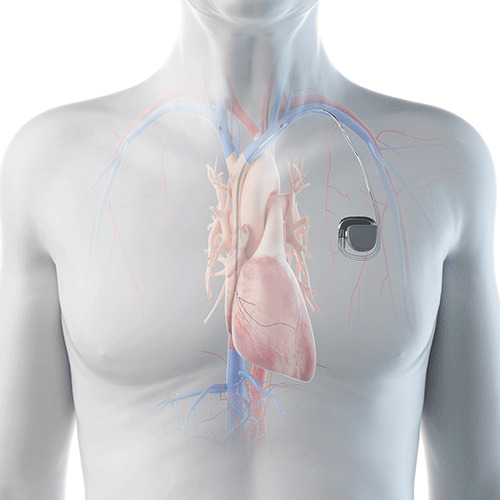 New wireless, rechargeable battery research aims to reduce surgical risks